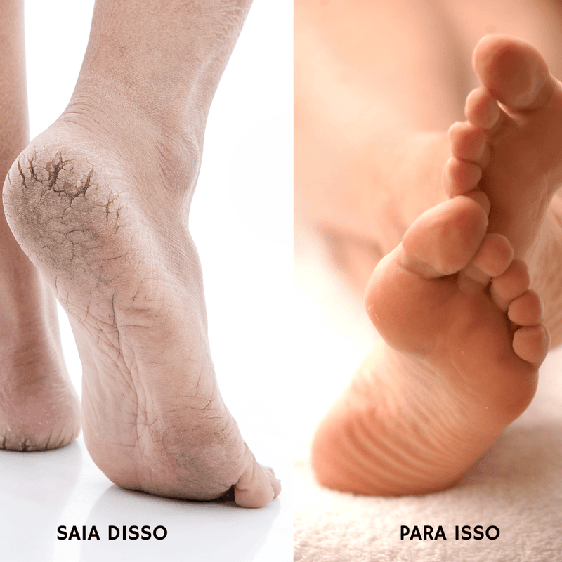 RevitaPés - Meia de silicone para pés ressecados e rachados